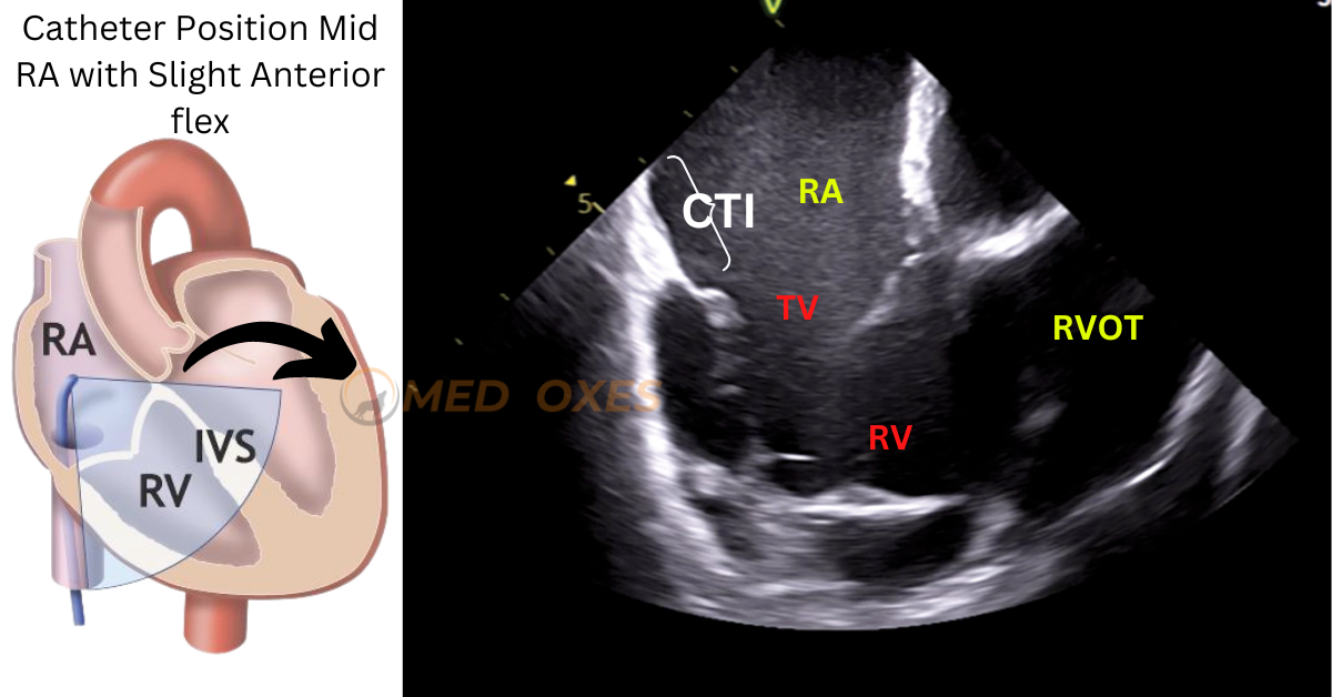 Intracardiac Echocardiography Catheter Manipulation Technique Medfoxes