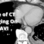 Multislice CT Imaging on Transcatheter Aortic Valve Implantation