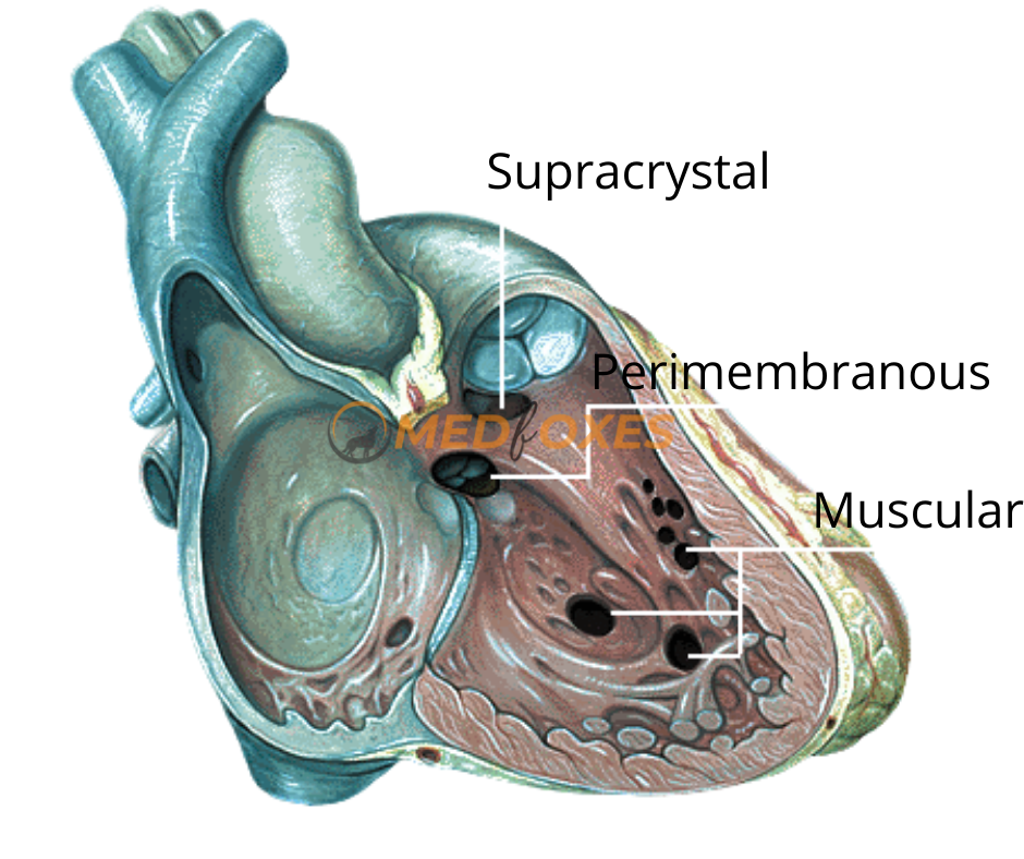 Types of VSD