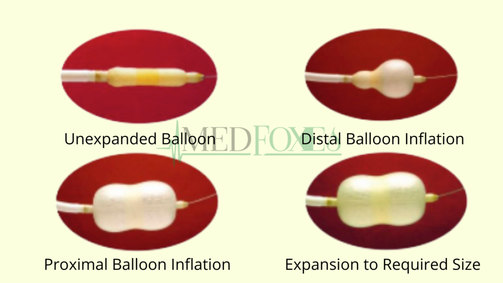 Balloon Mitral Valvuloplasty