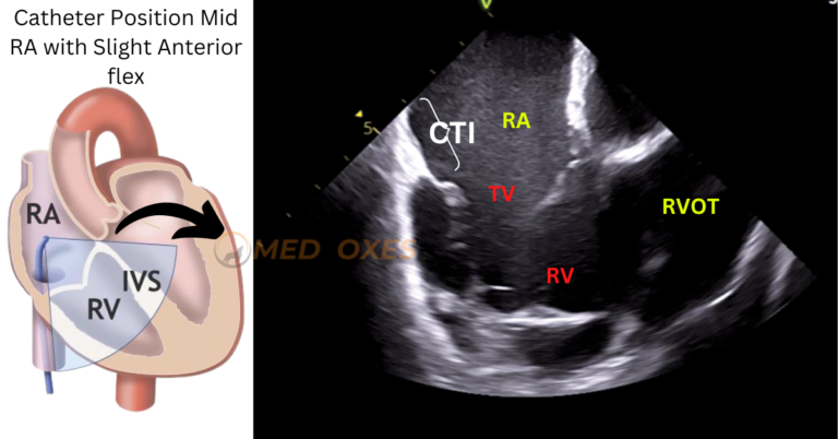 Intracardiac Echocardiography Catheter Manipulation Technique – MEDFOXES