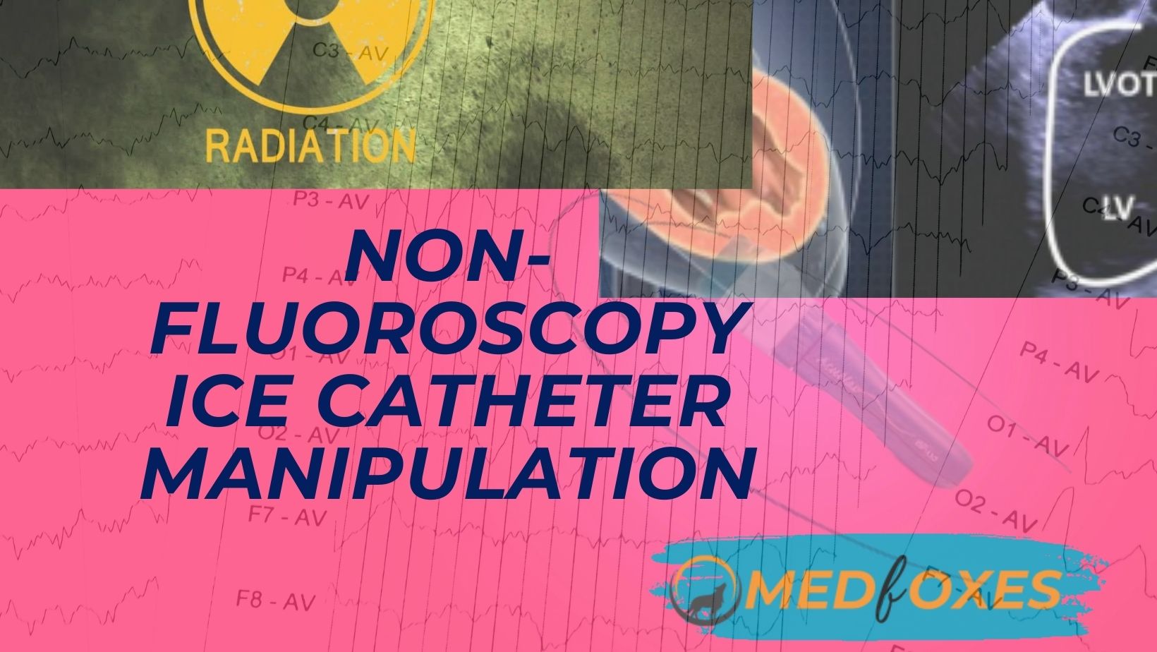 Non-Fluoroscopy ICE Catheter Manipulation