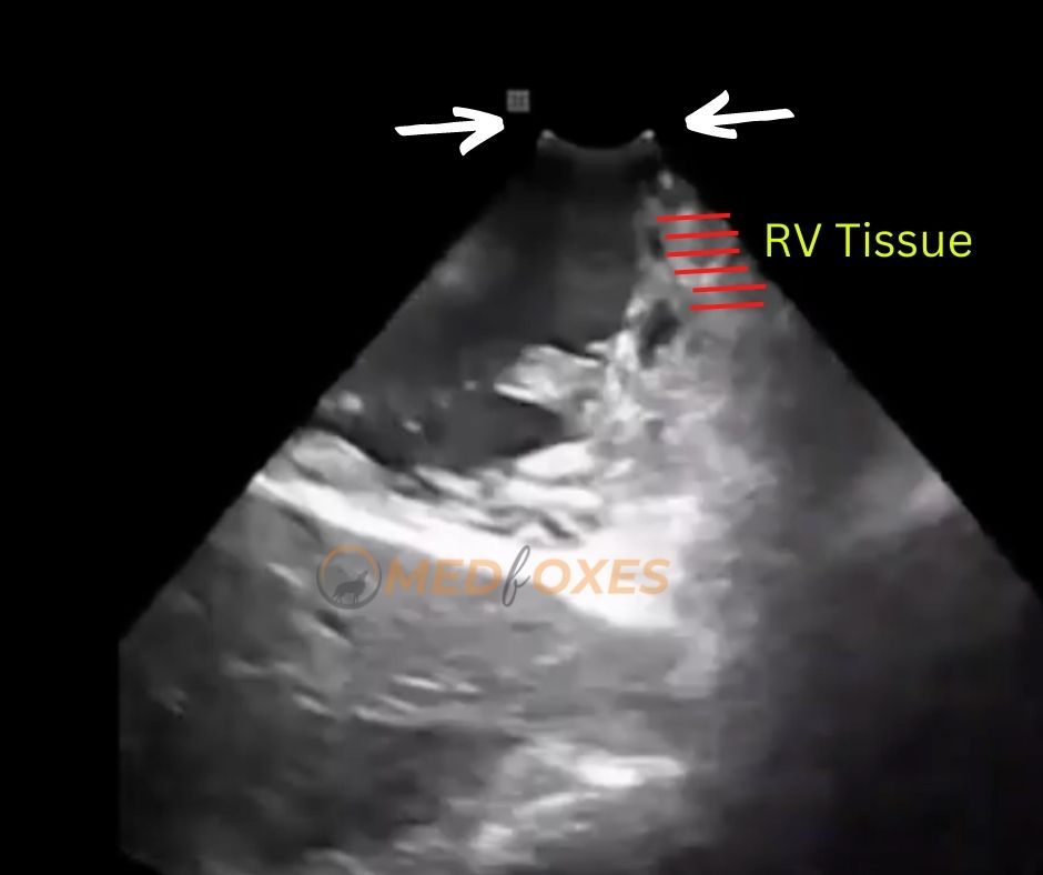 RV wall aligned with Tip of Catheter