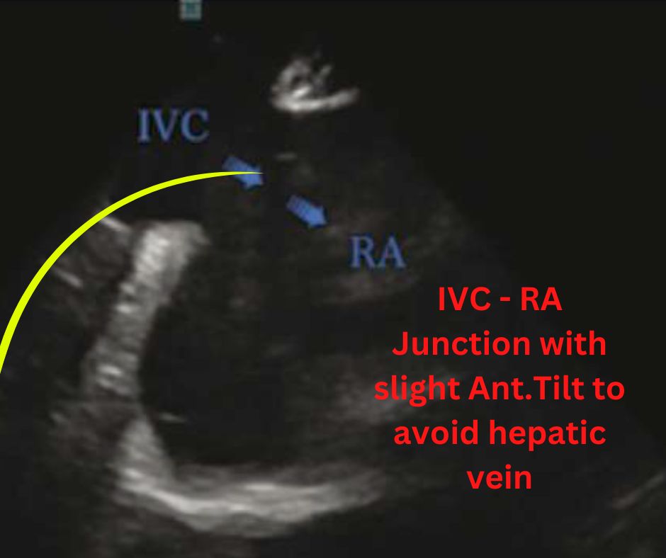 IVC-RA junction