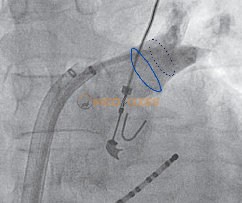Positioning the Circular Mapping Catheter (Lasso)