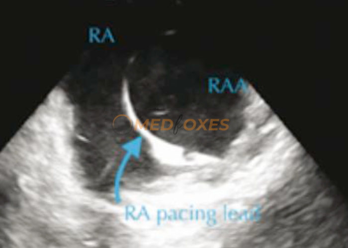 RA with Pacing Lead in Intracardiac echocardiography