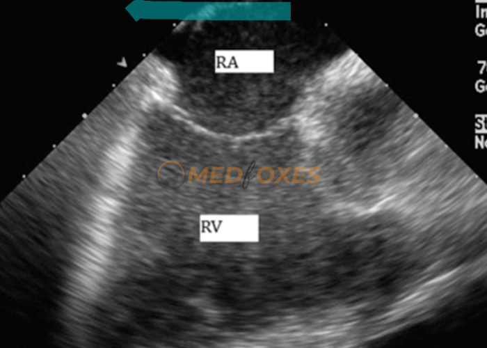 Right Ventricle in Intracardiac echocardiography
